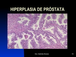 HIPERPLASIA DE PRÓSTATA 