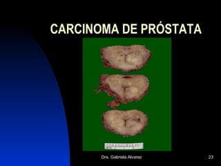 CARCINOMA DE PRÓSTATA 