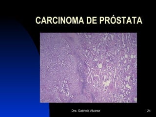 CARCINOMA DE PRÓSTATA 