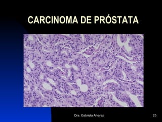 CARCINOMA DE PRÓSTATA 