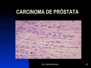 CARCINOMA DE PRÓSTATA 