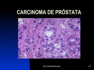 CARCINOMA DE PRÓSTATA 