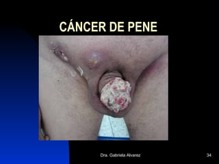 CÁNCER DE PENE 
