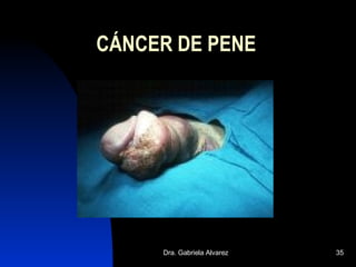 CÁNCER DE PENE 