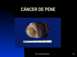 CÁNCER DE PENE 