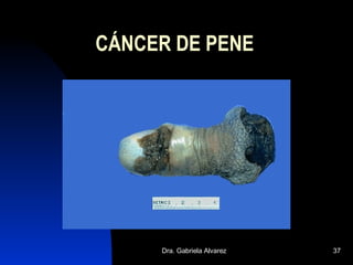 CÁNCER DE PENE 