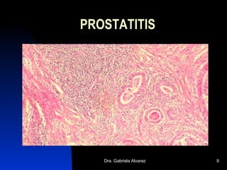PROSTATITIS 