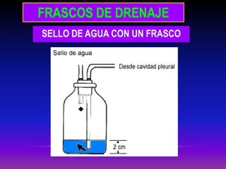FRASCOS DE DRENAJE
SELLO DE AGUA CON UN FRASCO
 