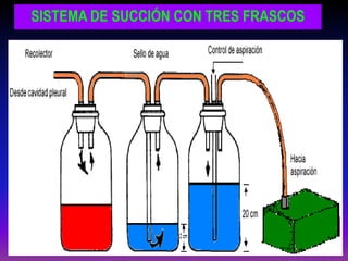 SISTEMA DE SUCCIÓN CON TRES FRASCOS
 
