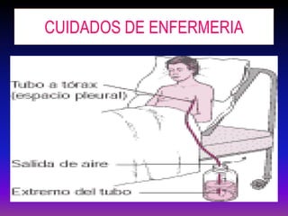CUIDADOS DE ENFERMERIA
 