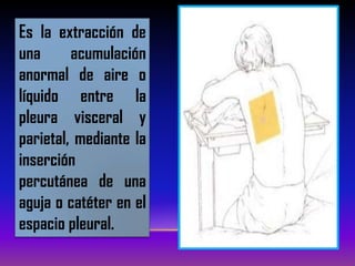 Es la extracción de
una acumulación
anormal de aire o
líquido entre la
pleura visceral y
parietal, mediante la
inserción
percutánea de una
aguja o catéter en el
espacio pleural.
 