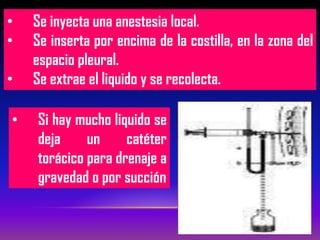 • Se inyecta una anestesia local.
• Se inserta por encima de la costilla, en la zona del
espacio pleural.
• Se extrae el liquido y se recolecta.
• Si hay mucho liquido se
deja un catéter
torácico para drenaje a
gravedad o por succión
 