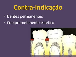 Contra‐indicação
• Dentes permanentes
• Comprome;mento esté;co
 