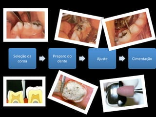Seleção da    Preparo do 
                            Ajuste    Cimentação
  coroa         dente
 