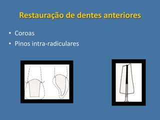Restauração de dentes anteriores 
• Coroas
• Pinos intra‐radiculares
 