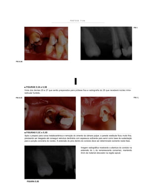 PRÓTESE    FIXA



                                                                                                                                      FIG 5.




FIG 5.3A




           ■ FIGURAS 5.3A e 5.3B
                                                                  I
           Vista dos dentes 25 e 27 que serão preparados para prótese fixa e radiografia do 25 que receberá núcleo intra-
           radicular fundido.

FIG 5.3C                                                                                                                              FIG 5.]




           ■ FIGURAS 5.3C e 5.3D
           Após o preparo para coroa metalocerâmica e remoção do cimento da câmara pulpar, a parede vestibular ficou muito fina,
           precisando ser desgasta até conseguir estrutura dentinária com espessura suficiente para servir como base de sustentação
           para a porção coronária do núcleo. A extensão do pino dentro do conduto deve ser determinado somente nesta fase.


                                                                         Imagem radiográfica mostrando a abertura do conduto na
                                                                         extensão do /3 do remanescente coroa/raiz, mantendo
                                                                         4mm de material obturador na região apical.




             FIGURA 5.3E
 