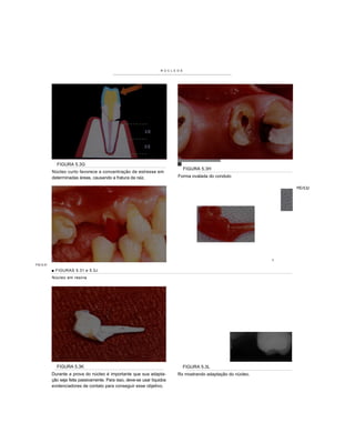 N Ú C L E O S




             FIGURA 5.3G
                                                                                     FIGURA 5.3H
           Núcleo curto favorece a concentração de estresse em
           determinadas áreas, causando a fratura da raiz.                     Forma ovalada do conduto

                                                                                                                       FIG 5.3J




                                                                                                                   1
FIG 5.31

           ■ FIGURAS 5.31 e 5.3J
           Núcleo em resina




             FIGURA 5.3K                                                             FIGURA 5.3L
           Durante a prova do núcleo é importante que sua adapta-              Rx mostrando adaptação do núcleo.
           ção seja feita passivamente. Para isso, deve-se usar líquidos
           evidenciadores de contato para conseguir esse objetivo.
 