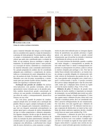 PRÓTESE   FIXA




FIG 5.3M




            FIGURAS 5.3M e 5.3N
           Vistas do núcleo e prótese cimentados.


           quais o material obturador não atingiu o nível desejado,      mento do pino intra-radicular para se conseguir alguma
           deve-se considerar dois aspectos o tempo de tratamento e      forma de paralelismo nas paredes próximas à região
           a presença de lesão periapical. Na presença desta, indica-    apical, e/ou aproveitar ao máximo a porção coronal
           se sempre o retratamento do conduto, dada a sua defi-         remanescente, que irá auxiliar na retenção e minimizar
           ciência que pode estar contribuindo para a evolução da        a distribuição de esforços na raiz do dente.
           lesão; na sua ausência, deve-se considerar o tempo de             Em casos extremos de destruição, quando o conduto
           tratamento. Se realizado há pelo menos 5 anos procede-        está muito alargado e, consequentente as paredes da
           se à execução do núcleo, mantendo-se o remanescente           raiz estão muito finas e o dente é estrategicamente im-
           do material obturador como comentado anteriormente.           portante no planejamento da prótese, pode-se utilizar
           Se a porção preparada do conduto não for considerada          os núcleos estojados para proteger a raiz. Este tipo de
           adequada para estabelecer o comprimento do núcleo,            núcleo busca retenção intra-radicular e, ao mesmo tem-
           indica-se o retratamento do canal, independente do tem-       po, protege as paredes delgadas do remanescente radi-
           po e da ausência de lesão. Em dentes cujos canais foram       cular, através do biselamento das paredes da raiz. As-
           obturados com cone de prata, recomenda-se o retrata-          sim, essas paredes serão protegidas com o metal com o
           mento para que possam receber núcleos fundidos, man-          qual é confeccionado o núcleo. A porção coronária
           tendo com segurança o selamento apical.                       deve prover espaço adequado para o tipo de coroa indi-
               Inclinação das paredes do conduto: Os núcleos             cado, sendo que a adaptação desta ocorrerá na região
           intra-radiculares com paredes inclinadas, além de             cervical do núcleo metálico. (Figs. 5.4A a 5.4G)
           apresentarem menor retenção que os de paredes para-               Diâmetro do pino: O diâmetro da porção intra-
           lelas também desenvolvem grande concentração de               radicular do núcleo metálico é importante na retenção
           esforços em suas paredes circundantes, podendo gerar          da restauração e na sua habilidade para resistir aos esfor-
           um efeito de cunha e, consequentemente, desenvolver           ços transmitidos durante a função mastigatória. E claro
           fraturas em sua volta.                                        que, quanto maior o diâmetro do pino, maior será a sua
               Em vista disso, quando do preparo do conduto,             retenção e resistência porém, deve ser considerado tam-
           especial atenção deve ser tomada com a inclinação das         bém o possível enfraquecimento da raiz remanescente.
           paredes. Busca-se seguir a própria inclinação do condu-       Em vista disto, tem sido sugerido que o diâmetro do
           to, que foi alargada pelo tratamento endodôntico, e           pino deve apresentar até 7 do diâmetro total da raiz e
           que terá seu desgaste aumentado principalmente na             que a espessura de dentina deve ser maior na face vesti-
           porção apical para a colocação do núcleo intraradicular,      bular dos dentes anteriores superiores devido a incidên-
           até que se tenha comprimento e diâmetro adequados.            cia de força ser maior neste sentido (Fig. 5.3F).
           Em algumas situações, devido ao tipo de abertura reali-           Clinicamente, o diâmetro do pino deve ser deter-
           zada durante o tratamento endodôntico, presença de            minado comparando-se através de um radiografia, o
           cáries ou remoção de pinos anteriormente colocados, o         diâmetro da broca com o do conduto. Cuidado espe-
           contudo pode ter suas paredes muito inclinadas e para         cial deve ser tomado na região do terço apical onde a
           compensar esta deficiência, o profissional deve lançar        largura mésio-distal é a porção mais estreita da raiz.
           mão de meios alternativos, como aumentar o compri-            Para que o metal utilizado apresente resistência satis-
 