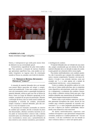 PRÓTESE   F I X A




■ FIGURAS 5.4F e 5.4G
Núcleo cimentado e imagem radiográfica.




fatória, é indi s pensável que tenha pelo menos lmm         à moldagem do conduto.
de diâmetro na sua extremidade apical.                          O material obturador deve ser retirado até essa exten-
   Característica superficial do pino intra-radicu-         são, sempre considerando que um mínimo de 4mm de
lar: Para aumentar a retenção de núcleos fundidos           material obturador deve ser deixado no ápice do condu-
que apresentam superfícies lisas, estas podem ser tor-      to para garantir um selamento efetivo nessa região.
nadas irregulares ou rugosas antes da cimentação                Para dentes multirradiculares com condutos parale-
usando-se brocas ou, jateadas com óxido de alumínio.        los, não é necessário que o preparo dos condutos apre-
                                                            sente o mesmo comprimento. Somente o de maior di-
     1 . 5 . REMOÇÃO DO MATERIAL OBTURADOR E                âmetro é levado à sua extensão máxima, como por
     PREPARO DO(S) CONDUTO(S)                               exemplo aos 2/3, e o outro apenas até a metade do
                                                            comprimento total da raiz - coroa remanescente.
    A remoção do material obturador deve ser iniciado             Como os condutos são paralelos, pode-se ter o nú-
com pontas Rhein aquecida s até atingir o compri-           cleo com os 2 pinos unidos pela base, que se comportam
mento pré-estabelecido. Como nem sempre é possível          como dispositivos anti-rotacionais; assim não é necessá-
com este instr umento retirar a quantidade desejada do      rio o alargamento e ovalamento dos condutos, buscan-
material obturado, utiliza-se para esse fim as brocas de    do-se atingir o diâmetro mínimo (lmm) para que a liga
Peeso, Gates ou Largo de diâmetro apropriado ao do          metálica mantenha suas características de resistência, evi-
conduto, acoplado de um guia de penetração. Durante         tando assim desgaste desnecessário de dentina.
a utilização da broca, deve-se tomar muito cuidado em             Dentes como os pré-molares superiores, que po-
acompanhar a extensão do conduto, procurando                dem apresentar divergência das raízes, devem ter seu
sempre visualizar o material obturador, para não cor-       conduto mais volumoso preparado na extensão con-
rer-se o risco de trepanar a raiz.                          vencional (2/3) e o outro preparado parcialmente ape-
    Na presença de retenções acentuadas no interior         nas com o objetivo de conferir estabilidade, funcio-
do conduto (por exemplo, devido à remoção de pinos          nando como dispositivo anti-rotacional.
mal direcionados, abertura coronária incorreta ou cá-             Os dentes multirradiculares superiores com
rie) pode ser àesaconseháve remover toda a dentina        condutos divergentes e que apresentam remanescente
necessária para sua eliminação para não enfraquecer a       coronário, prepara-se o conduto palatino até 2/ da sua
raiz; recomenda-se, nesses caso, o preenchimento da         extensão, e um dos vestibulares até sua metade (o
área retentiva com cimento ionomérico, previamente          mais volumoso deles) e o outro terá apenas parte
 