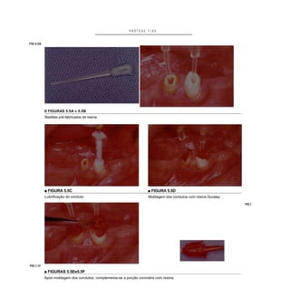 PRÓTESE FIXA


FIG 5.5A




           II FIGURAS 5.5A e 5.5B
           Bastões pré-fabricados de resina.




           ■ FIGURA 5.5C                                             ■ FIGURA 5.5D
           Lubrificação do conduto                                   Moldagem dos condutos com resina Duralay.
                                                                                                                 FIG 5




FIG 5.5E

           ■ FIGURAS 5.5Ee5.5F
           Após moldagem dos condutos, complementa-se a porção coronária com resina.
 