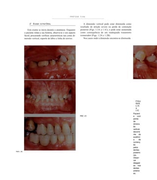 PRÓTESE   FIXA



                   2' EXAME    EXTRA 'O RAL                                    A dimensão vertical pode estar diminuída como
                                                                            resultado de atrição severa ou perda de contenção
                  Este exame se inicia durante a anamnese. Enquanto         posterior (Figs. 1.1A a 1.1C), e pode estar aumentada
              o paciente relata a sua história, observa-se o seu aspecto    como consequência de um inadequado tratamento
              facial, procurando verificar características tais como di-    restaurador (Figs. 1.2A e 1.2B).
              mensão vertical, suporte de lábio e linha do sorriso.             Nos casos onde a dimensão encontra-se diminuída




                                                                                                                                      FIGU
                                                                                                                                      RAS
                                                                                                                                      LIA
                                                                                                                                      a
                                                                                                                                      I.IC
                                                                                                                                    Pacient
                                                                            FIG I.2A                                                e com
                                                                                                                                    perda
                                                                                                                                    de
                                                                                                                                    dimens
                                                                                                                                    ão
                                                                                                                                    vertical,
                                                                                                                                    decorre
                                                                                                                                    nte da
                                                                                                                                    ausênci
                                                                                                                                    a     de
                                                                                                                                    contenç
                                                                                                                                    ão
                                                                                                                                    pelos
                                                                                                                                    dentes
FIG I . I A
                                                                                                                                    posterio
                                                                                                                                    res.
                                                                                                                                    Obser-
                                                                                                                                    var
                                                                                                                                    desgast
                                                                                                                                    es nos
                                                                                                                                    dentes
                                                                                                                                    anterior
                                                                                                                                    es,
 