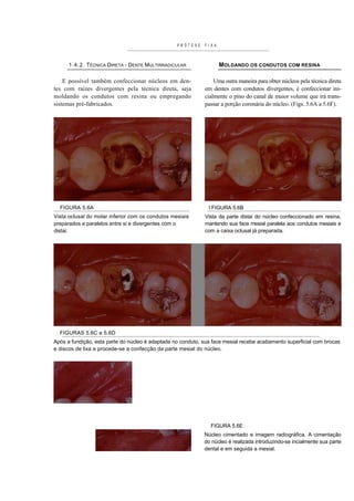 PRÓTESE    FI XA



      1.4.2. TÉCNICA DIRETA - DENTE MULTIRRADICULAR                  MOLDANDO OS CONDUTOS COM RESINA

    E possível também confeccionar núcleos em den-               Uma outra maneira para obter núcleos pela técnica direta
tes com raízes divergentes pela técnica direta, seja         em dentes com condutos divergentes, é confeccionar ini-
moldando os condutos com resina ou empregando                cialmente o pino do canal de maior volume que irá trans-
sistemas pré-fabricados.                                     passar a porção coronária do núcleo. (Figs. 5.6A a 5.6F).




  FIGURA 5.6A                                                  I FIGURA 5.6B
Vista oclusal do molar inferior com os condutos mesiais      Vista da parte distai do núcleo confeccionado em resina,
preparados e paralelos entre si e divergentes com o          mantendo sua face mesial paralela aos condutos mesiais e
distai.                                                      com a caixa oclusal já preparada.




  FIGURAS 5.6C e 5.6D
Após a fundição, esta parte do núcleo é adaptada no conduto, sua face mesial recebe acabamento superficial com brocas
e discos de lixa e procede-se a confecção da parte mesial do núcleo.




                                                                FIGURA 5.6E
                                                             Núcleo cimentado e imagem radiográfica. A cimentação
                                                             do núcleo é realizada introduzindo-se incialmente sua parte
                                                             dental e em seguida a mesial.
 