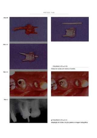 PRÓTESE   FIXA


FIG 5.7E




FIG 5.7G




                        FIGURAS 5.7E a 5.7G
                      Vistas do núcleo em resina e fundido.

FIG 5.7H




 FIG 5.7J




                      ■ FIGURAS 5.7H a 5.7J
                      Adaptação do núcleo, do pino palatino e imagem radiográfica.
 