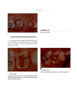 NÚCL E O S




                                                              ■ FIGURA 5.7K
                                                               Núcleo cimentado.


     COM PINO PRÉ-FABRICADO (SISTEMA PARAPOST)

    Este sistema apresenta pinos pré-fabricados em me-
tal e em plástico, com paredes paralelas e serrilhadas,
em vários diâmetros e com suas respectivas brocas.
(Figs. 5.8A a 5.81)




                                                                    FIGURA 5.8B
                                                               Pino metálico liso posicionado no conduto vestibular
  FIGURA 5.8A
Vista oclusal do molar com os condutos palatino e disto-
vestibular preparados e com o pino de plástico já posicio-
nado no conduto palatino.
 