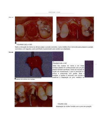 PRÓTESE        FIXA




F I G 5 .8 C




                 FIGURAS 5.8C e 5.8D
               Após a colocação da resina na câmara pulpar e porção coronária, o pino metálico liso é removido para preparar a porção
               coronária e, em seguida, o pino serrilhado é posicionado para avaliar sua adaptação.

FIG 5.8E




                                                                       : J í-
                                                                       FIGURAS 5.8E e 5.8F
                                                                       Vistas dos núcleos em resina e em metal.
                                                                       Conduto palatino foi confeccionado com um pino
                                                                       plástico também serrilhado. Antes da inclusão do
                                                                       núcleo em revestimento, o pino é removido e o
                                                                       orifício é preenchido com grafite. Após a
                                                                       fundição, o grafite é removido com brocas e
                                                                       avalia-se a adaptação do pino metálico no
                interior do orifício do núcleo.




                                                                                  FIGURA 5.8G
                                                                                Adaptação do núcleo fundido com o pino em posição.
 