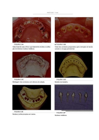 PRÓTESE   FIXA




  FIGURA 5.9A                                                      ■ FIGURA 5.9B
Vista inicial de caso clínico cujo tratamento envolve a confec-    Vista dos condutos preparados após remoção do tecido
ção de diversos núcleos metálicos.                                 cariado e cirurgia periodontal.




  FIGURA 5.9C                                                        FIGURA 5.9D
Moldagem dos condutos com silicona de adição.                      Modelo de trabalho.




  FIGURA 5.9E
                                                                     FIGURA 5.9F
Núcleos confeccionados em resina.
                                                                   Núcleos metálicos.
 