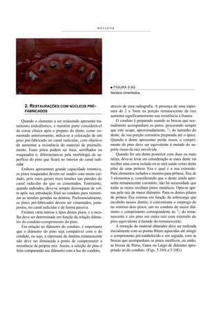 NÚCLEOS




                                                           ■ FIGURA 5.9G
                                                           Núcleos cimentados.



     2. RESTAURAÇÕES COM NÚCLEOS PRÉ-                      através de uma radiografia. A presença de uma espes-
     FABRICADOS                                            sura de 2 a 3mm na porção remanescente da raiz
                                                           aumenta significantemente sua resistência à fratura.
    Quando o elemento a ser restaurado apresenta tra-          O conduto é preparado usando as brocas que nor-
tamento endodôntico, e mantém parte considerável           malmente acompanham os pinos, procurando sempre
da coroa clínica após o preparo do dente, como co-         que este ocupe, aproximadamente, 2/3 do tamanho do
mentado anteriormente, indica-se a colocação de um         dente, de sua porção coronária preparada até o ápice.
pino pré-fabricado no canal radicular, com objetivo        Quando o dente apresentar perda óssea, o compri-
de aumentar a resistência do material de preenchi-         mento do pino deve ser equivalente à metade do su-
mento. Esses pinos podem ser lisos, serrilhados ou         porte ósseo da raiz envolvida.
rosqueados e, diferenciam-se pela morfologia da su-            Quando for um dente posterior com duas ou mais
perfície do pino que ficará no interior do canal radi-     raízes, deve-se levar em consideração se esses dente vai
cular.                                                     receber uma coroa isolada ou se será usado como dente
    Embora apresentem grande capacidade retentiva,         pilar de uma prótese fixa e qual é a sua extensão.
os pinos rosqueados devem ser usados com muito cui-        Para elementos isolados e mesmo para prótese, fixa de
dado, pois estes geram mais tensões nas paredes do         3 elementos e, considerando que o dente ainda apre-
canal radicular do que os cimentados. Entretanto,          senta remanescente coronário, não há necessidade que
quando indicados, deve-se sempre desrosquear de vol-       todas as raízes recebam pinos metálicos. Opta-se ape-
ta após sua introdução final no conduto para minimi-       nas pela raiz de maior diâmetro. Para os dentes pilares
zar as tensões geradas na dentina. Preferencialmente,      de prótese fixa extensa em função da sobrecarga que
os pinos pré-fabricados devem ser cimentados, justa-       incidirão nesses dentes, é conveniente o emprego de
postos, no canal radicular e de forma passiva.             no mínimo dois pinos, um no conduto de maior diâ-
    Existem vária marcas e tipos desses pinos, e a esco-   metro e comprimento correspondente ao 2/3 do rema-
lha deve ser determinada em função da relação diâme-       nescente e um pino em outra raiz com extensão do
tro do conduto-comprimento do pino.                        pino equivalente à metade do remanescente.
    Em relação ao diâmetro do conduto, é importante            A remoção do material obturador deve ser realizada
que o diâmetro do pino seja compatível com o do            inicialmente com as pontas Rhein aquecidas até atingir
conduto, ou seja, a espessura de dentina remanescente      o comprimento pré-estabelecido e em seguida, com as
não deve ser diminuída a ponto de comprometer a            brocas que acompanham os pinos metálicos, ou então,
resistência da própria raiz. Assim, a seleção do pino é    as brocas de Peeso, Gates ou Largo de diâmetro apro-
feita comparando seu diâmetro com a luz do conduto,        priado ao do conduto. (Figs. 5.10A a 5.10G)
 