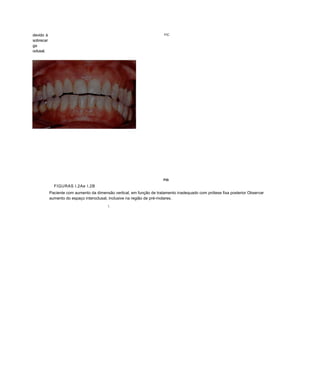 devido à                                                               FIC
sobrecar
ga
oclusal.




                                                                       FIG

             FIGURAS l.2Ae I.2B
           Paciente com aumento da dimensão vertical, em função de tratamento inadequado com prótese fixa posterior Observar
           aumento do espaço interoclusal, inclusive na região de pré-molares.
                                         
 