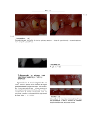 NÚCLEOS



                                                                                                                              FIG 5.I0F




FIG 5.I0E

              FIGURAS 5 . I 0 E e 5 . I 0 F
            O pino é cimentado com fosfato de zinco ou ionômero de vidro e o núcleo de preenchimento é confeccionado com
            resina composta ou compômero.




                                                                     ■ FIGURA 5.I0G
                                                                     Rx após cimentação.




                 ?. CONFECÇÃO  DE NÚCLEO COM
                 REAPROVEITAMENTO DE PRÓTESE
                 EXISTENTE

               A principal causa de fracasso em prótese fixa é a
            cárie e por isso, próteses fixas cimentada há algum
            tempo apresentam-se com seus dentes pilares caria-
            dos. Nesses casos e desde que a prótese apresente-se
            em condições de permanecer na boca, pode-se confec-
            cionar o núcleo da maneira convencional, sendo que
            sua porção coronária é obtida moldando-se a interior
            da coroa. (Figs. 5.1 IA a 5.1 IN)
                                                                       FIGURA 5.1 IA
                                                                     Vista vestibular de uma prótese metalocerâmica 19 anos
                                                                     após a cimentação. O dente 24 necessitou de tratamento
                                                                     endodôntico decorrente de processo carioso.
 