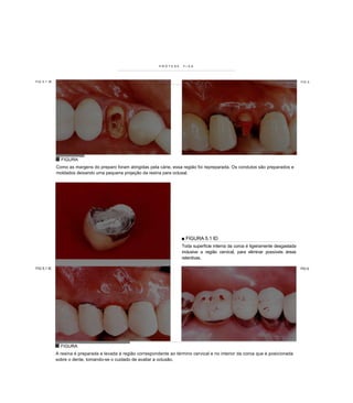 PRÓTESE     FIXA




FIG 5.1 IB                                                                                                                            FIG 5




               FIGURA
             Como as margens do preparo foram atingidas pela cárie, essa região foi repreparada. Os condutos são preparados e
             moldados deixando uma pequena projeção da resina para oclusal.




                                                                         ■ FIGURA 5.1 ID
                                                                         Toda superfície interna da coroa é ligeiramente desgastada
                                                                         inclusive a região cervical, para eliminar possíveis áreas
                                                                         retentivas.

FIG 5.1 IE                                                                                                                            FIG 5.




               FIGURA
             A resina é preparada e levada à região correspondente ao término cervical e no interior da coroa que é posicionada
             sobre o dente, tomando-se o cuidado de avaliar a oclusão.
 