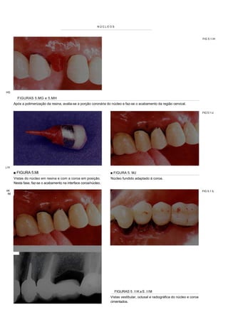 NÚCLEOS



                                                                                                                                    FIG 5.1 IH




HG

          FIGURAS 5.MG e 5.MH
        Após a polimerização da resina, avalia-se a porção coronária do núcleo e faz-se o acabamento da região cervical.

                                                                                                                                    FIG 5.1 IJ




j.lll

        ■ FIGURA 5.Ml                                                 ■ FIGURA 5. MJ
        Vistas do núcleo em resina e com a coroa em posição.           Núcleo fundido adaptado à coroa.
        Nesta fase, faz-se o acabamento na interface coroa/núcleo.

 IIK                                                                                                                                FIG 5.1 IL
   IM




                                                                         FIGURAS 5 . I I K a S . I I M
                                                                      Vistas vestibular, oclusal e radiográfica do núcleo e coroa
                                                                      cimentados.
 