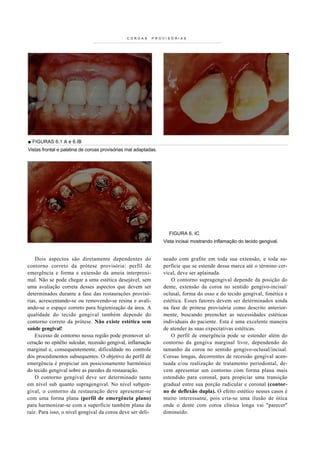 COROAS         PROVISÓRIAS




■ FIGURAS 6.1 A e 6.IB
Vistas frontal e palatina de coroas provisórias mal adaptadas.




                                                                   FIGURA 6. IC
                                                                 Vista incisai mostrando inflamação do tecido gengival.


    Dois aspectos são diretamente dependentes do                 neado com grafite em toda sua extensão, e toda su-
contorno correto da prótese provisória: perfil de                perfície que se estende dessa marca até o término cer-
emergência e forma e extensão da ameia interproxi-               vical, deve ser aplainada.
mal. Não se pode chegar a uma estética desejável, sem                O contorno supragengival depende da posição do
uma avaliação correta desses aspectos que devem ser              dente, extensão da coroa no sentido gengivo-incisal/
determinados durante a fase das restaurações provisó-            oclusal, forma do osso e do tecido gengival, fonética e
rias, acrescentando-se ou removendo-se resina e avali-           estética. Esses fatores devem ser determinados ainda
ando-se o espaço correto para higienização da área. A            na fase de prótese provisória como descrito anterior-
qualidade do tecido gengival também depende do                   mente, buscando preencher as necessidades estéticas
contorno correto da prótese. Não existe estética sem             individuais do paciente. Esta é uma excelente maneira
saúde gengival!                                                  de atender às suas expectativas estéticas.
    Excesso de contorno nessa região pode promover ul-               O perfil de emergência pode se estender além do
ceração no epitélio sulcular, recessão gengival, inflamação      contorno da gengiva marginal livre, dependendo do
marginal e, consequentemente, dificuldade no controle            tamanho da coroa no sentido gengivo-oclusal/incisal.
dos procedimentos subsequentes. O objetivo do perfil de          Coroas longas, decorrentes de recessão gengival acen-
emergência é propiciar um posicionamento harmónico               tuada e/ou realização de tratamento periodontal, de-
do tecido gengival sobre as paredes da restauração.              vem apresentar um contorno com forma plana mais
    O contorno gengival deve ser determinado tanto               estendido para coronal, para propiciar uma transição
em nível sub quanto supragengival. No nível subgen-              gradual entre sua porção radicular e coronal (contor-
gival, o contorno da restauração deve apresentar-se              no de deflexão dupla). O efeito estético nesses casos é
com uma forma plana (perfil de emergência plano)                 muito interessante, pois cria-se uma ilusão de ótica
para harmonizar-se com a superfície também plana da              onde o dente com coroa clínica longa vai "parecer"
raiz. Para isso, o nível gengival da coroa deve ser deli-        diminuído.
 