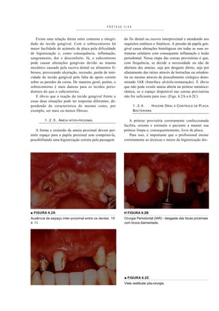 PRÓTESE FIXA



   Existe uma relação direta entre contorno e integri-    do fio dental ou escova interproximal e atendendo aos
dade do tecido gengival. Com o sobrecontorno há           requisitos estéticos e fonéticos. A pressão da papila gen-
maior facilidade de acúmulo de placa pela dificuldade     gival causa alterações histológicas em todas as suas es-
de higienização e, como consequência, inflamação,         truturas celulares com consequente inflamação e lesão
sangramento, dor e desconforto. Já, o subcontorno         periodontal. Nessa etapa das coroas provisórias é que,
pode causar alterações gengivais devido ao trauma         com frequência, se decide a necessidade ou não de
mecânico causado pela escova dental ou alimentos fi-      abertura das ameias, seja por desgaste direto, seja por
brosos, provocando ulceração, recessão, perda de toni-    afastamento das raízes através de borrachas ou ortodon-
cidade do tecido gengival pela falta de apoio correto     tia ou mesmo através de procedimento cirúrgico deno-
sobre as paredes da coroa. De maneira geral, porém, o     minado IAR (Interface alvéolo-restauração). É óbvio
sobrecontorno é mais danoso para os tecidos perio-        que não pode existir ameia aberta na prótese metaloce-
dontais do que o subcontorno.                             râmica, se o espaço disponível nas coroas provisórias
   E óbvio que a reação do tecido gengival frente a       não for suficiente para isso. (Figs. 6.2A a 6.2C)
essas duas situações pode ter respostas diferentes, de-
pendendo da característica do mesmo como, por                   1 .2.4.     H IGIENE O RAL   E   C ONTROLE   DE   P LACA
exemplo, ser mais ou menos fibroso.                             B ACTERIANA

         1 . 2 . 5 . A MEIA   INTER - PROXIMAL               A prótese provisória corretamente confeccionada
                                                          facilita, orienta e estimula o paciente a manter sua
   A forma e extensão da ameia proximal devem per-        prótese limpa e, consequentemente, livre de placa.
mitir espaço para a papila proximal sem comprimi-la,          Para isso, é importante que o profissional ensine
possibilitando uma higienização correta pela passagem     corretamente as técnicas e meios de higienização dis-




■ FIGURA 6.2A                                             H FIGURA 6.2B
Ausência de espaço inter-proximal entre os dentes 10      Cirurgia Periodontal (IAR) - desgaste das faces proximais
e I I.                                                    com broca diamantada.




                                                          ■ FIGURA 6.2C
                                                          Vista vestibular pós-cirurgia.
 