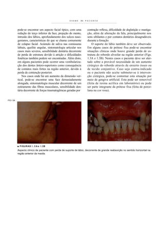 E X A M E   DO   PACIENTE




           pode-se encontrar um aspecto facial típico, com uma            contração reflexa, dificuldade de deglutição e mastiga-
           redução do terço inferior da face, projeção do mento,          ção, além de alteração da fala, principalmente nos
           intrusão dos lábios, aprofundamento dos sulcos naso-           sons sibilantes e por contatos dentários desagradáveis
           genianos, características do que se chama comumente            durante a fonação.
           de colapso facial. Acúmulo de saliva nas comissuras                O suporte do lábio também deve ser observado.
           labiais, queilite angular, sintomatologia articular nos        Em alguns casos de prótese fixa pode-se encontrar
           casos mais severos, sensibilidade dentária decorrente          situações clínicas onde houve grande perda de es-
           de perda de estrutura devido à atrição e dificuldades          trutura do rebordo alveolar na região anterior (Figs.
           fonéticas também podem ser encontradas. Além disto,            1.3A e 1.3B). Nestes casos o paciente deve ser aler-
           em alguns pacientes pode ocorrer uma vestibulariza-            tado sobre a provável necessidade de um aumento
           ção dos dentes ântero-superiores como consequência             cirúrgico do rebordo através de enxerto ósseo ou
           de contatos mais fortes na região anterior, devido à           de tecido conjuntivo. Caso seja contra-indicado
           perda de contenção posterior.                                  ou o paciente não aceite submeter-se à interven-
               Nos casos onde há um aumento da dimensão ver-              ção cirúrgica, pode-se contornar esta situação por
           tical, pode-se encontrar uma face demasiadamente               meio de gengiva artificial. Esta pode ser removível
           alongada, sintomatologia muscular decorrente de um             (feita de resina acrílica em laboratório) ou pode
           estiramento das fibras musculares, sensibilidade den-          ser parte integrante da prótese fixa (feita de porce-
           tária decorrente de forças traumatogêmcas geradas por          lana na cor rosa).


FIG I.3A




           ■ FIGUR AS l . 3 A e I.3B
           Aspecto clínico de paciente com perda de suporte de lábio, decorrente de grande reabsorção no sentido horizontal na
           região anterior da maxila.
 