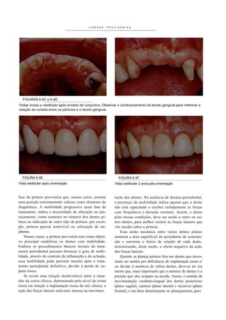 COROAS       PROVISÓRIAS




  FIGURAS 6.4C e 6.4D
Vistas incisai e vestibular após enxerto de conjuntivo. Observar o condicionamento do tecido gengival para melhorar a
relação de contato entre os pônticos e o tecido gengival.




  FIGURA 6.4E                                                   FIGURA 6.4F
Vista vestibular após cimentação.                            Vista vestibular 2 anos pós-cimentação


fase da prótese provisória que, nesses casos, assume         tação dos dentes. Na ausência de doença periodontal,
uma posição extremamente valiosa como elemento de            a presença da mobilidade indica apenas que o dente
diagnóstico. A mobilidade progressiva nesta fase de          não está capacitado a receber isoladamente as forças
tratamento, indica a necessidade de alteração no pla-        com frequência e duração normais. Assim, o dente
nejamento, como aumento no número dos dentes pi-             pilar nessas condições, deve ser unido a outro ou ou-
lares ou indicação de outro tipo de prótese, por exem-       tros dentes, para melhor resistir às forças laterais que
plo, prótese parcial removível ou colocação de im-           vão incidir sobre a prótese.
plantes.                                                         Essa união mecânica entre vários dentes pilares
    Nesses casos, a prótese provisória tem como objeti-      aumenta a área superficial do periodonto de sustenta-
vo principal estabilizar os dentes com mobilidade.           ção e reorienta o fulcro de rotação de cada dente,
Embora os procedimentos básicos iniciais do trata-           minimizando, deste modo, o efeito negativo da ação
mento periodontal possam diminuir o grau de mobi-            das forças laterais.
lidade, através do controle da inflamação e da oclusão,          Quando se planeja prótese fixa em dentes que neces-
essa mobilidade pode persistir mesmo após o trata-           sitam ser unidos por deficiência de implantação óssea e/
mento periodontal definitivo, devido à perda do su-          ou devido à ausência de vários dentes, deve-se ter em
porte ósseo.                                                 mente que, mais importante que o número de dentes é a
    Se existe uma relação desfavorável entre o tama-         posição que eles ocupam na arcada. Assim, o sentido de
nho da coroa clínica, determinada pelo nível da crista       movimentação vestíbulo-lingual dos dentes posteriores
óssea em relação à implantação óssea da raiz clínica, a      (plano sagital), caninos (plano lateral) e incisivos (plano
ação das forças laterais será mais intensa na movimen-       frontal), é um fator determinante no planejamento, pois
 