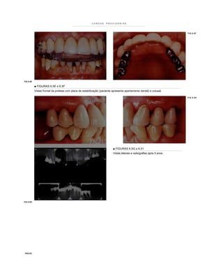 COROAS      PROVISÓRIAS




                                                                                                                         FIG 6.5F




FIG 6.5E

            ■ FIGURAS 6.5E e 6.5F
            Vistas frontal da prótese com placa de estabilização (paciente apresenta apertamento dental) e oclusal.

                                                                                                                         F I G 6 .5 H




                                                                           ■ FIGURAS 6.5G a 6.51
                                                                           Vistas laterais e radiografias após 5 anos.




FIG 6.5G




 FIG 6.51
 