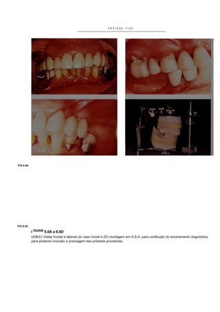 PRÓTESE    FIXA




FIG 6.6A




FIG 6.6C

           i FIGURAS 6.6A a 6.6D
           (A/B/C) Vistas frontal e laterais do caso inicial e (D) montagem em A.S.A. para confecção do enceramento diagnóstico
           para posterior inclusão e prensagem das próteses provisórias.
 