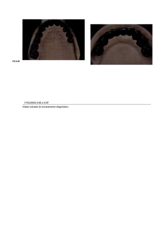 FIG 6.6E




            I FIGURAS 6.6E e 6.6F
           Vistas oclusais do enceramento diagnóstico.
 