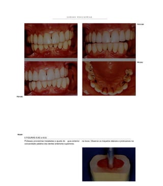 COROAS    PROVISÓRIAS




                                                                                                                                 FIG 6.6H




                                                                                                                                 FIG 6.6J




FIG 6.6G




 FIG 6.61
            II FIGURAS 6.6G a 6.6J
            Próteses provisórias instaladas e ajuste do guia anterior   na boca. Observe os traçados laterais e protrusivos na
            concavidade palatina dos dentes anteriores superiores.
 