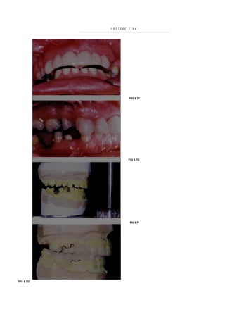 PRÓTESE   FIXA




                     FIG 6.7F




                     FIG 6.7G




                      FIG 6.71




FIG 6.7D
 