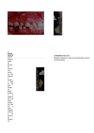 ■
FIGUR
AS 6.7D       ■ FIGURAS 6.7G a 6.71
A 6.7F
              Modelos montados em ASA na nova dimensão e encera-
Determi       mento das placas.
nação
da
Dimens
ão
Vertical
com
auxilio
do JIG.
Observe
a
escultur
a dada
ao JIG
para
facilitar
os
testes
fonético
s         e
estéticos
(D) e as
vistas
laterais
em MIH
(E)       e
após
restabel
eciment
o       da
Dimens
ão
Vertical.
(F)
 
