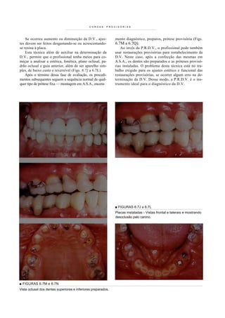 COROAS      PROVISÓRIAS




    Se ocorreu aumento ou diminuição da D.V., ajus-            mento diagnóstico, preparos, prótese provisória (Figs.
tes devem ser feitos desgastando-se ou acrescentando-          6.7M a 6.7Q).
se resina à placa.                                                 Ao invés da P.R.D.V., o profissional pode também
    Esta técnica além de auxiliar na determinação da           usar restaurações provisórias para restabelecimento da
D.V., permite que o profissional tenha meios para co-          D.V. Neste caso, após a confecção das mesmas em
meçar a analisar a estética, fonética, plano oclusal, pa-      A.S.A., os dentes são preparados e as próteses provisó-
drão oclusal e guia anterior, além de ser aparelho sim-        rias instaladas. O problema desta técnica está no tra-
ples, de baixo custo e reversível (Figs. 6.7] a 6.7L).         balho exigido para os ajustes estético e funcional das
    Após o término dessa fase de avaliação, os procedi-        restaurações provisórias, se ocorrer algum erro na de-
mentos subsequentes seguem a sequência normal de qual-         terminação da D.V. Desse modo, a P.R.D.V. é o ins-
quer tipo de prótese fixa — montagem em A.S.A., encera-        trumento i deal para o dia gnóstico da D.V.




                                                               ■ FIGURAS 6.7J a 6.7L
                                                               Placas instaladas - Vistas frontal e laterais e mostrando
                                                               desoclusão pelo canino.




■ FIGURAS 6.7M e 6.7N
Vista oclusal dos dentes superiores e inferiores preparados.
 