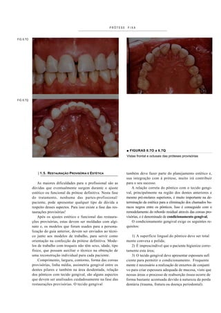 PRÓTESE    FIXA


FIG 6.7O




FIG 6.7Q




                                                                         ■ FIGURAS 6.7O a 6.7Q
                                                                         Vistas frontal e oclusais das próteses provisórias




               | 1.5. RESTAURAÇÃO PROVISÓRIA E ESTÉTICA                  também deve fazer parte do planejamento estético e,
                                                                         sua integração com à prótese, muito irá contribuir
               As maiores dificuldades para o profissional são as        para o seu sucesso.
           dúvidas que eventualmente surgem durante o ajuste                 A relação correta do pôntico com o tecido gengi-
           estético ou funcional da prótese definitiva. Nesta fase       val, principalmente na região dos dentes anteriores e
           do tratamento, nenhuma das partes-profissional/               mesmo pré-molares superiores, é muito importante na de-
           paciente, pode apresentar qualquer tipo de dúvida a           terminação da estética para a eliminação dos chamados bu-
           respeito desses aspectos. Para isso existe a fase das res-    racos negros entre os pônticos. Isso é conseguido com o
           taurações provisórias!                                        remodelamento do rebordo residual através das coroas pro-
               Após os ajustes estético e funcional das restaura-        visórias, e é denominado de condicionamento gengival.
           ções provisórias, estas devem ser moldadas com algi-              O condicionamento gengival exige os seguintes re-
           nato e, os modelos que foram usados para a persona-           quisitos:
           lização do guia anterior, devem ser enviados ao técni-
           co junto aos modelos de trabalho, para servir como               1) A superfície lingual do pôntico deve ser total
           orientação na confecção da prótese definitiva. Mode-          mente convexa e polida;
           los de trabalho com troqueis não têm sexo, idade, tipo           2) É imprescindível que o paciente higienize corre-
           físico, que possam auxiliar o técnico na obtenção de          tamente esta área;
           uma reconstrução individual para cada paciente.                  3) O tecido gengival deve apresentar espessura sufi
               Comprimento, largura, contorno, forma das coroas          ciente para permitir o condicionamento. Frequente
           provisórias, linha média, assimetria gengival entre os        mente é necessário a realização de enxertos de conjunti
           dentes pilares e também na área desdentada, relação           vo para criar espessura adequada de mucosa, visto que
           dos pônticos com tecido gengival, são alguns aspectos         nessas áreas o processo de reabsorção óssea ocorre de
           que devem ser analisados cuidadosamente na fase das           forma bastante acentuada devido à natureza da perda
           restaurações provisórias. O tecido gengival                   dentária (trauma, fratura ou doença periodontal).
 