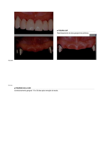 ■ FIGURA 6.8F
                                                                      Reembasamento da área gengival dos pônticos.




FIG 6.8F




FIG 6.8J

           ■ FIGURAS 6.8J e 6.8H
           Condicionamento gengival 15 e 30 dias após remoção do tecido.
 