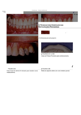 COROAS       PROVISÓRIAS
FIG 6.81
   6.8K




                                                                   2) TÉCNICAS PARA CONFECÇÃO DAS
                                                                   RESTAURAÇÕES PROVISÓRIAS


                                                                                                                  _   .
                                                                                                                  *




                                                                   2.1) COM MOLDE DE ALGINATO




                                                                       ■ FIGURAS 6.81 a 6.8K
                                                                       Vistas da Prótese Provisória após condicionamento.




                                                                                                                            i
             FIGURA 6.9A                                               ■ FIGURA 6.9B
           Vista inicial do dente 24 indicado para receber coroa       Molde de alginato obtido com uma moldeira parcial.
           metalocerâmica.
 