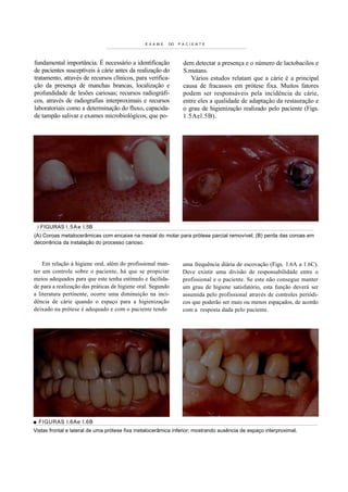 E XA ME   DO   PACIENTE




fundamental importância. É necessário a identificação           dem detectar a presença e o número de lactobacilos e
de pacientes susceptíveis à cárie antes da realização do        S.mutans.
tratamento, através de recursos clínicos, para verifica-           Vários estudos relatam que a cárie é a principal
ção da presença de manchas brancas, localização e               causa de fracassos em prótese fixa. Muitos fatores
profundidade de lesões cariosas; recursos radiográfi-           podem ser responsáveis pela incidência de cárie,
cos, através de radiografias interproximais e recursos          entre eles a qualidade de adaptação da restauração e
laboratoriais como a determinação do fluxo, capacida-           o grau de higienização realizado pelo paciente (Figs.
de tampão salivar e exames microbiológicos, que po-             1.5Ael.5B).




 i FIGURAS l . 5 A e I.5B
(A) Coroas metalocerâmicas com encaixe na mesial do molar para prótese parcial removível; (B) perda das coroas em
decorrência da instalação do processo carioso.



    Em relação à higiene oral, além do profissional man-       uma frequência diária de escovação (Figs. 1.6A a 1.6C).
ter um controle sobre o paciente, há que se propiciar          Deve existir uma divisão de responsabilidade entre o
meios adequados para que este tenha estímulo e facilida-       profissional e o paciente. Se este não consegue manter
de para a realização das práticas de higiene oral. Segundo     um grau de higiene satisfatório, esta função deverá ser
a literatura pertinente, ocorre uma diminuição na inci-        assumida pelo profissional através de controles periódi-
dência de cárie quando o espaço para a higienização            cos que poderão ser mais ou menos espaçados, de acordo
deixado na prótese é adequado e com o paciente tendo           com a resposta dada pelo paciente.




■ FIGURAS l.6Ae I.6B
Vistas frontal e lateral de uma prótese fixa metalocerâmica inferior; mostrando ausência de espaço interproximal.
 